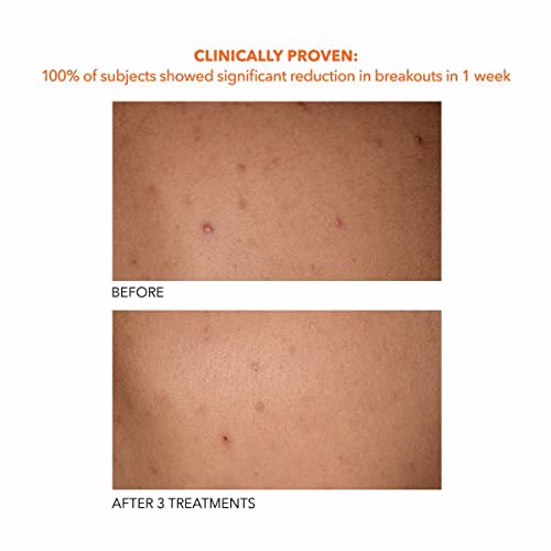 Dr Dennis Gross Alpha Beta Exfoliating Body Treatment Peel 7