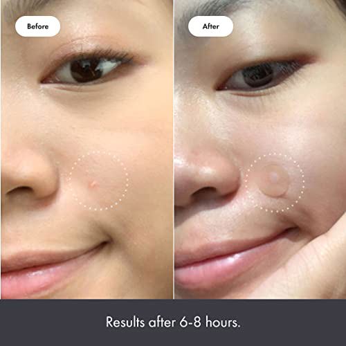Mighty Patch Original from Hero Cosmetics - Hydrocolloid Acne Pimple Patch 4